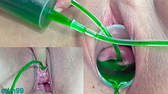 Cervix and Pee Hole Inflation with Injections for Japanese Lesbians Thumb